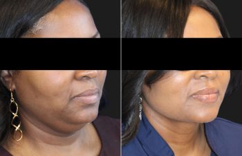 50 year-old patient before and 3 months after a deep plane neck lift and neck liposuction