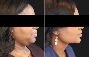 50 year-old patient before and 3 months after a deep plane neck lift and neck liposuction