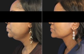 50 year-old patient before and 3 months after a deep plane neck lift and neck liposuction