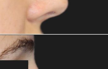 17 Year-Old Before and 7 Weeks After Rhinoplasty | Final Results Expected in 1 Year