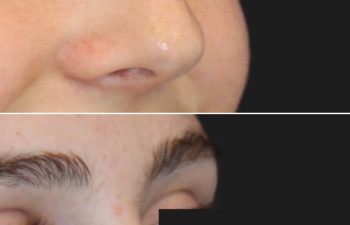 17 Year-Old Before and 7 Weeks After Rhinoplasty | Final Results Expected in 1 Year