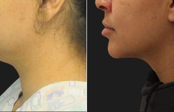 44 Year-Old Patient Before and 2 Months After Awake Neck Liposuction