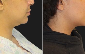 44 Year-Old Patient Before and 2 Months After Awake Neck Liposuction