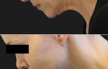 Before and after side profile images of a person showing differences in the lower face and neck area.