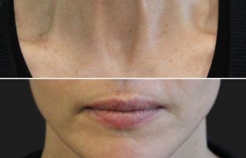 Before and after images of a person's neck, showcasing changes in skin appearance and texture.