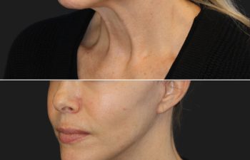 Side-by-side comparison of a woman's jawline before and after a cosmetic procedure, showing smoother skin in the after image.