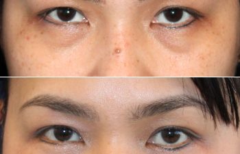 45 year-old patient before and 4 months after under eye bag removal and nanofat under the eyes