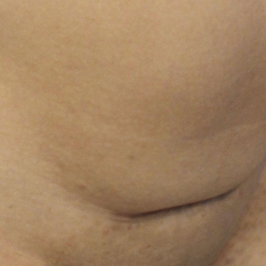 41 year-old woman was frustrated with hanging skin over her indented c-section scar.