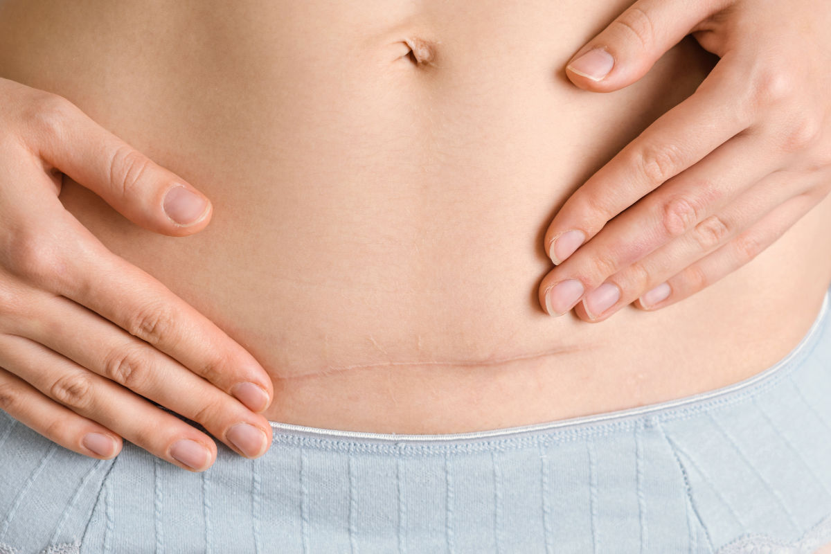 Close-up of a woman's abdomen after a cesarean section a year later.