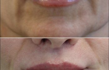 Close-up of a person's mouth showing a comparison of lips before and after a cosmetic procedure, focusing on changes in lip fullness and contour.