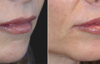 Before and after side-by-side images of a woman's mouth and lips, highlighting changes in lip fullness and skin texture.