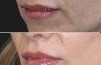 Close-up of a woman's lower face with focus on the lips, showing a side-by-side comparison before and after a cosmetic treatment.