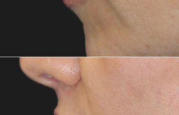 Side-by-side comparison of a person's lower face before and after a procedure, showing smoother skin and fuller lips in the after image.