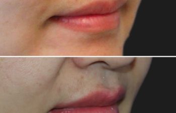 Before and after images showing lip enhancement with increased volume and definition.