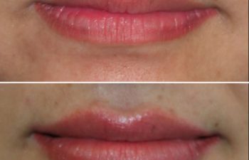 Close-up of lips in a before-and-after sequence with subtle changes in fullness and color.