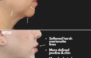 Side profile comparison of a woman's face before and after dermal fillers, highlighting softened marionette lines, defined jawline and chin, and plump lips.