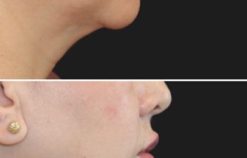 Side-by-side profile views of a person's face before and after a cosmetic procedure, showing a reduction in chin and neck sagging.