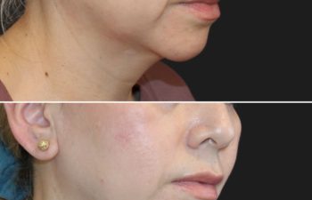 Before and after images showing the side profile of a woman's face, highlighting skin smoothing and enhanced jawline definition.