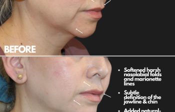 Before and after images showing effects of dermal fillers on nasolabial folds, jawline, and lips. The after image highlights softened lines and added volume.