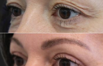 46 Year-Old Before and 3 Months After Awake Upper Eyelid Lift