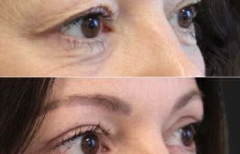 46 Year-Old Before and 3 Months After Awake Upper Eyelid Lift