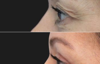 46 Year-Old Before and 3 Months After Awake Upper Eyelid Lift