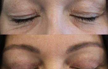 46 Year-Old Before and 3 Months After Awake Upper Eyelid Lift