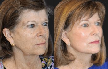 Side-by-side images of an older woman before and after a facial treatment, showing smoother skin and reduced wrinkles in the "after" image.