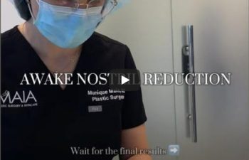 A surgeon in scrubs and mask performing awake nostril reduction surgery on a patient lying down, with text overlay about the procedure's details.