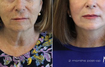 Side-by-side comparison of a woman's face showing before and after results of a cosmetic procedure over two months. The left shows wrinkles; the right shows smoother skin.