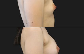 24 year-old patient before and 3 month after breast augmentation, breast lift, and areola reduction (tuberous breast correction). Tattoos have been edited out upon the patient’s request.