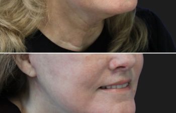 67 year-old patient before and 4 weeks after: Deep Plane Facelift, Deep Plane Neck Lift, Upper & Lower Blepharoplasty, Brow Lift, Fat Grafting to the Face, Lip Lift, Buccal Fat Pad Removal, and CO2 Laser Skin Resurfacing.