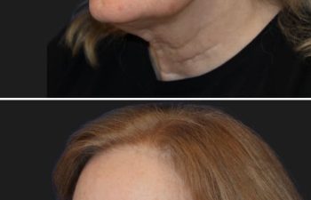 67 year-old patient before and 4 weeks after: Deep Plane Facelift, Deep Plane Neck Lift, Upper & Lower Blepharoplasty, Brow Lift, Fat Grafting to the Face, Lip Lift, Buccal Fat Pad Removal, and CO2 Laser Skin Resurfacing.