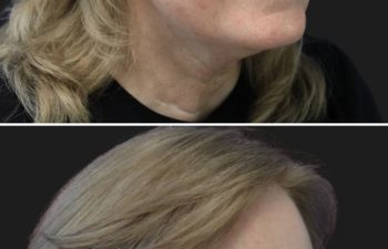 67 year-old patient before and 4 weeks after: Deep Plane Facelift, Deep Plane Neck Lift, Upper & Lower Blepharoplasty, Brow Lift, Fat Grafting to the Face, Lip Lift, Buccal Fat Pad Removal, and CO2 Laser Skin Resurfacing.