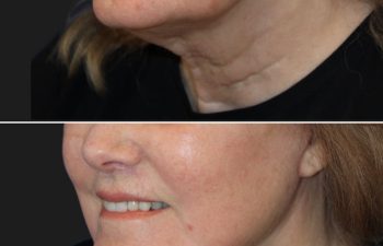 67 year-old patient before and 4 weeks after: Deep Plane Facelift, Deep Plane Neck Lift, Upper & Lower Blepharoplasty, Brow Lift, Fat Grafting to the Face, Lip Lift, Buccal Fat Pad Removal, and CO2 Laser Skin Resurfacing.