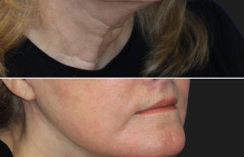 67 year-old patient before and 4 weeks after: Deep Plane Facelift, Deep Plane Neck Lift, Upper & Lower Blepharoplasty, Brow Lift, Fat Grafting to the Face, Lip Lift, Buccal Fat Pad Removal, and CO2 Laser Skin Resurfacing.