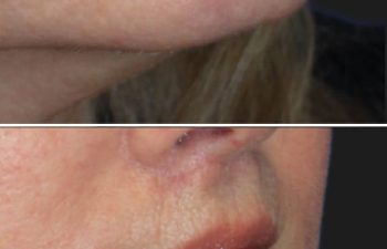 67 year-old patient before and 4 weeks after: Deep Plane Facelift, Deep Plane Neck Lift, Upper & Lower Blepharoplasty, Brow Lift, Fat Grafting to the Face, Lip Lift, Buccal Fat Pad Removal, and CO2 Laser Skin Resurfacing.