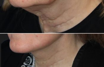 67 year-old patient before and 4 weeks after: Deep Plane Facelift, Deep Plane Neck Lift, Upper & Lower Blepharoplasty, Brow Lift, Fat Grafting to the Face, Lip Lift, Buccal Fat Pad Removal, and CO2 Laser Skin Resurfacing.