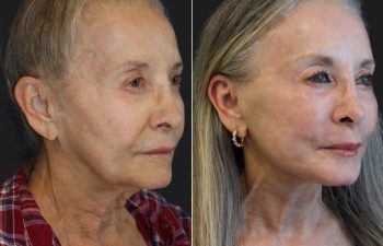 72 year-old patient before and 8 weeks after a deep plane facelift, deep plane neck lift, lower blepharoplasty, brow lift, fat grafting to the face, CO2 laser skin resurfacing, and a touch of lip filler.