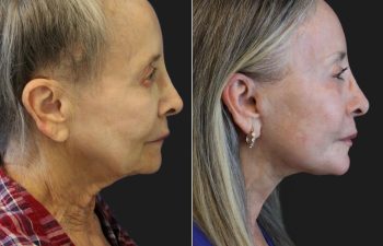 72 year-old patient before and 8 weeks after a deep plane facelift, deep plane neck lift, lower blepharoplasty, brow lift, fat grafting to the face, CO2 laser skin resurfacing, and a touch of lip filler.