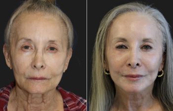 73-year-old patient before and 4 months post-op deep plane facelift.