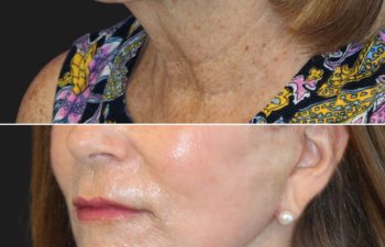 Side-by-side comparison of a woman's lower face and neck before and after 6 weeks of surgery. The skin appears smoother and firmer in the after image.