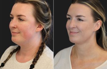 31 year-old bride-to-be before and 6 weeks after awake neck liposuction.