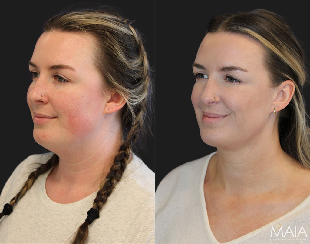 Photo of a 31 year-old bride-to-be, before and 6 weeks after awake neck liposuction.