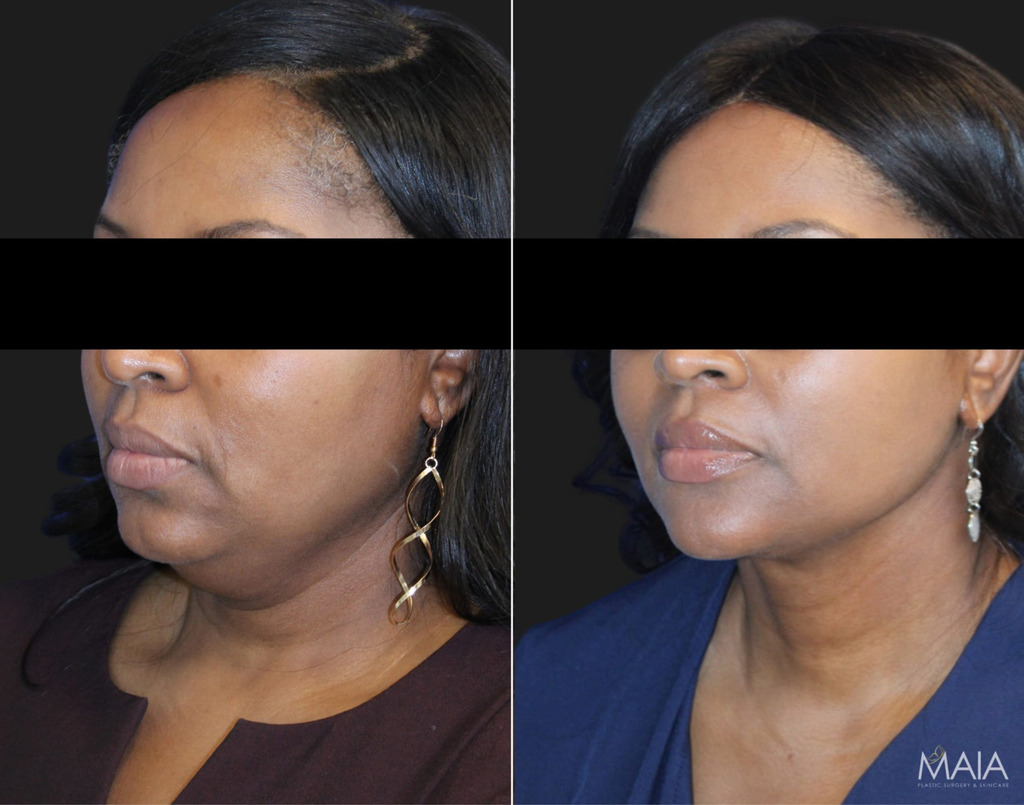 Photo of a 50 year-old patient, before and 3 months after a deep plane neck lift, mini facelift, and neck liposuction.