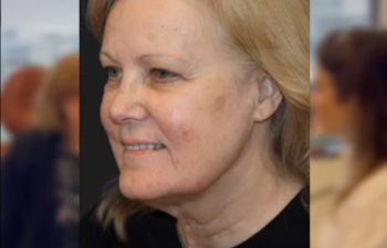 67 year-old patient before and 4 weeks after: Deep Plane Facelift, Deep Plane Neck Lift, Upper & Lower Blepharoplasty, Brow Lift, Fat Grafting to the Face, Lip Lift, Buccal Fat Pad Removal, and CO2 Laser Skin Resurfacing.