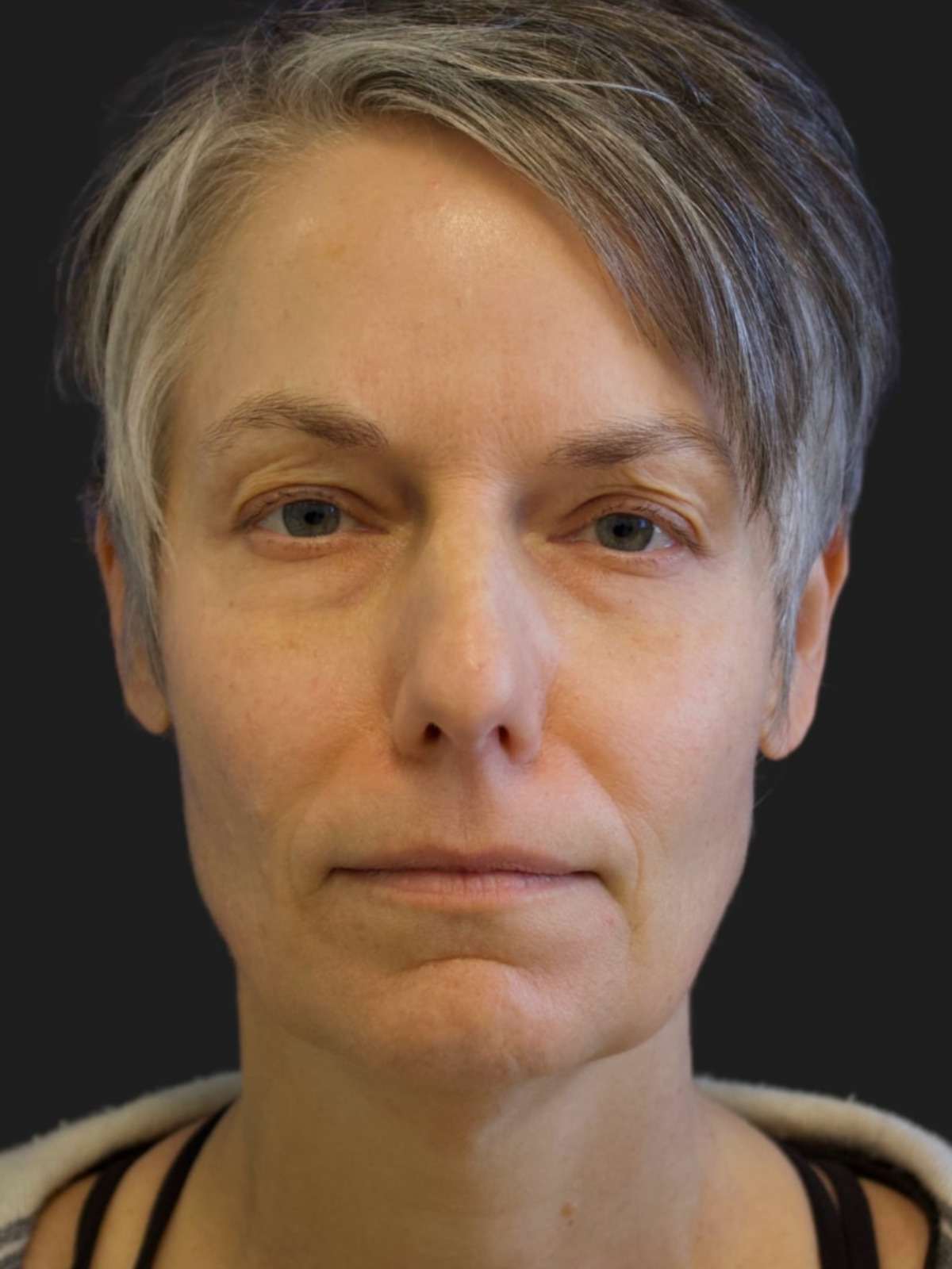 49 year-old patient 2.5 before a facelift, neck lift, fat grafting to the face, upper blepharoplasty, lower blepharoplasty, and TCA peel. Click to view our upper belpharoplasty before and after gallery.