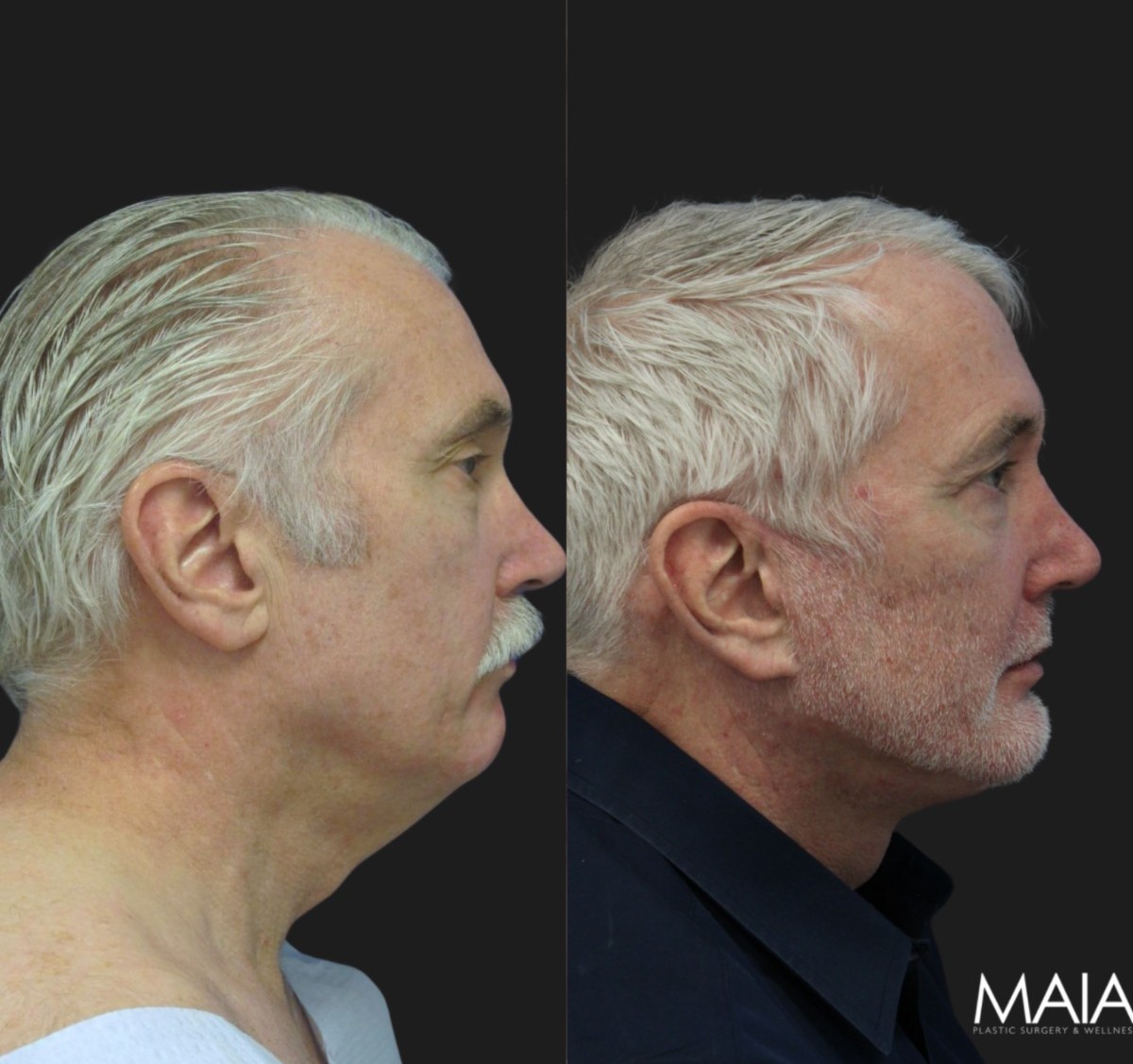 61 year old patient before and after facelift.