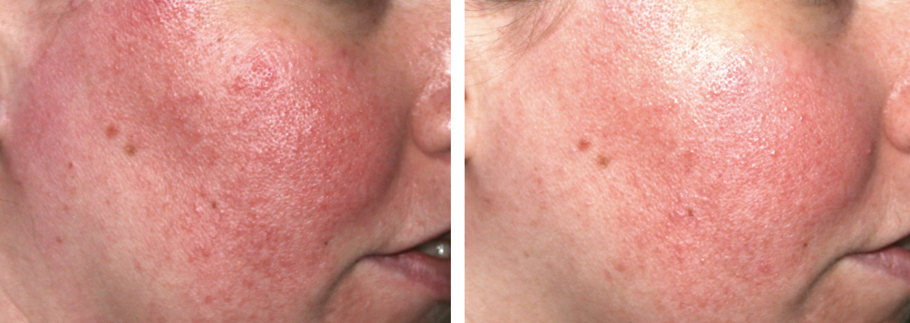 Results from a real patient using the IS Clinical Pro-Heal Serum Advance+