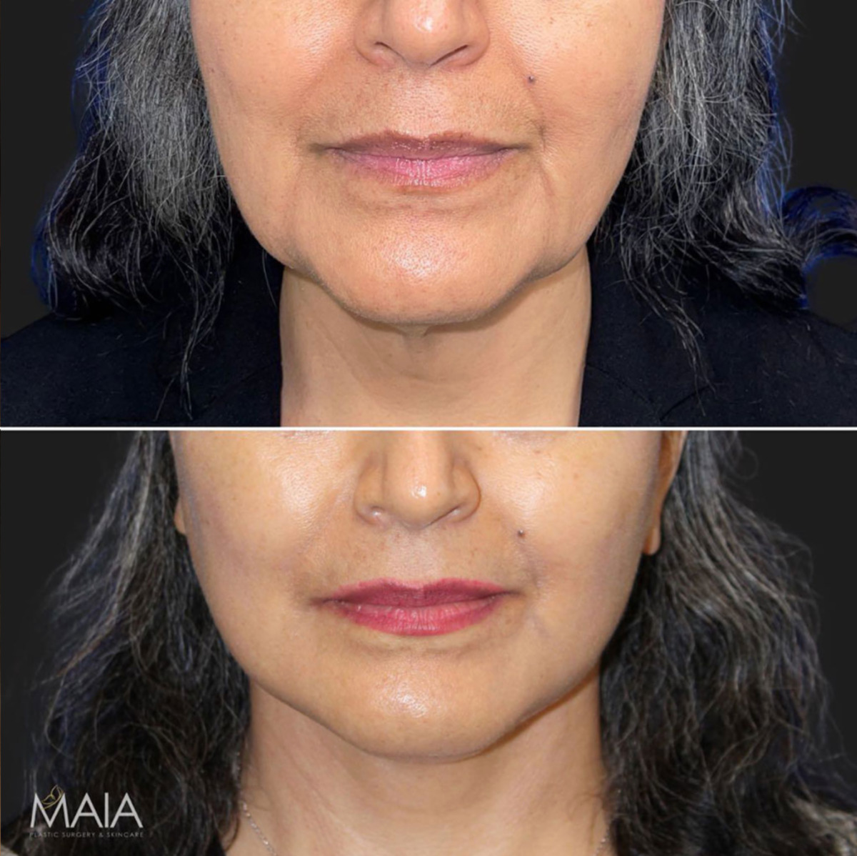 62 year-old patient before and after mini facelift, mini neck lift, facial fat grafting, nanofat grafting, and Morpheus8.